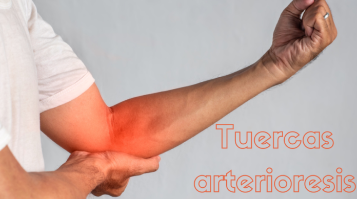 tuercas arterioresis